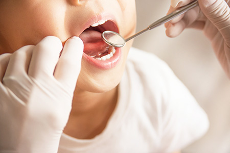 虫歯に感染しやすい時期