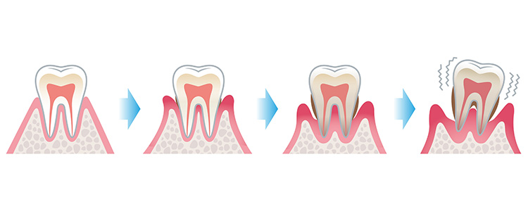 成人の8割が予備軍、またはすでに発症している「歯周病」