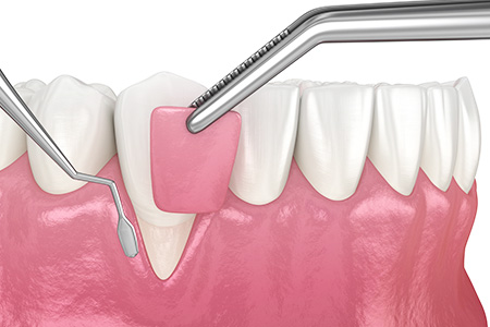 重度歯周病は歯ぐきの再生も行います